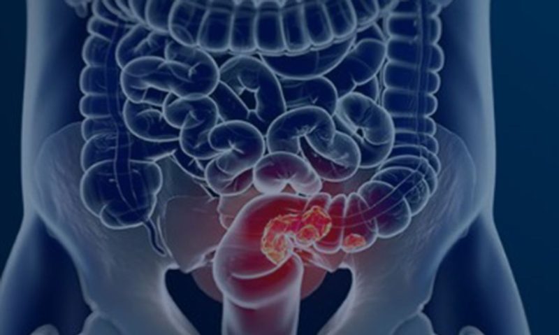 Saúde – Câncer de intestino deve ter 145 novos casos por dia no Brasil em 2026