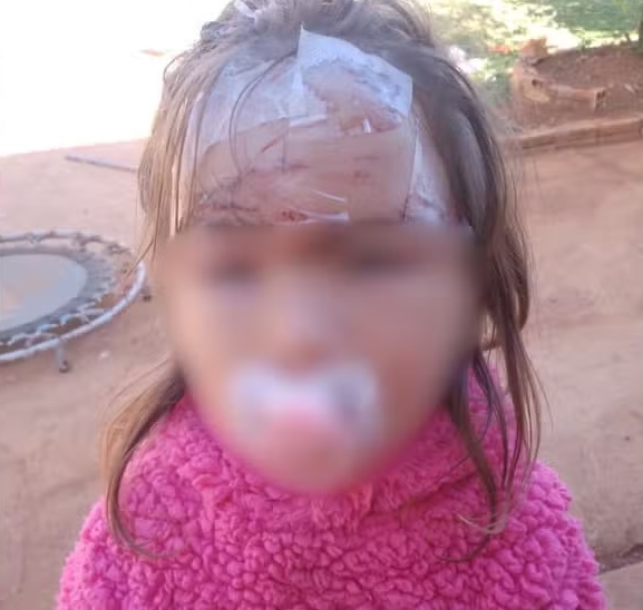 Paraná – Criança de 3 anos leva 27 pontos no rosto após ser atacada por cachorro no dia do aniversário