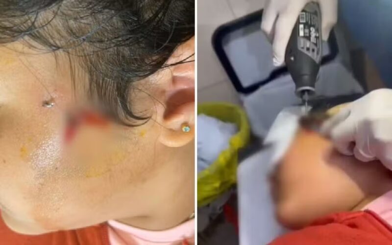 Goiás – Criança fica com anzol preso no rosto durante pescaria